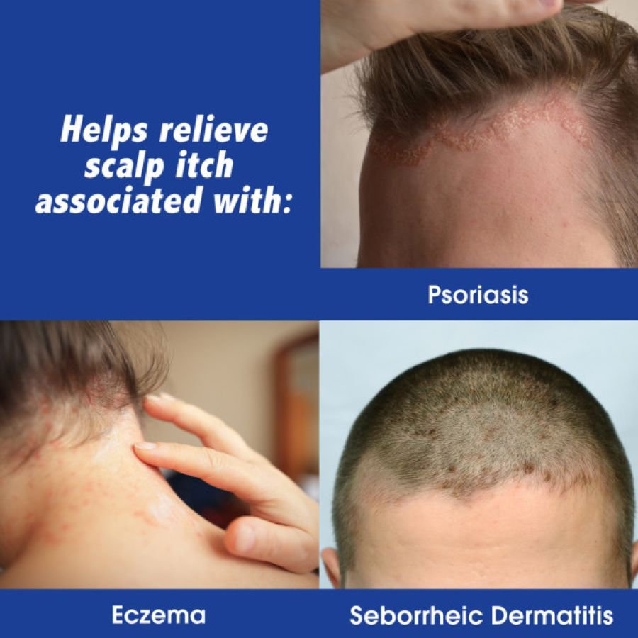 Scalpicin Max Strength Scalp Itch Treatment