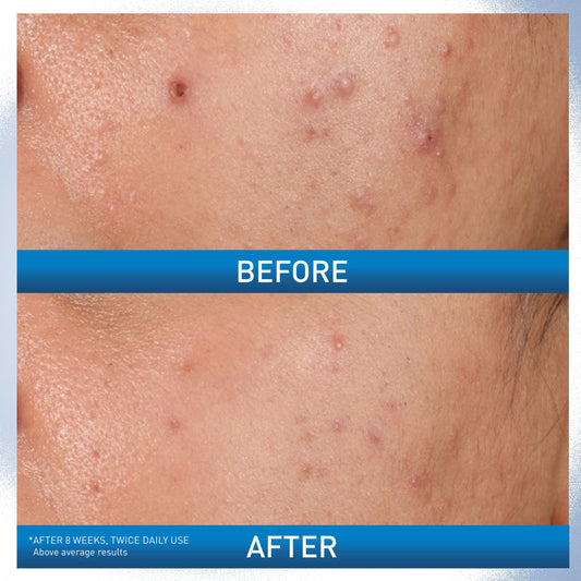 CeraVe Acne Control Gel