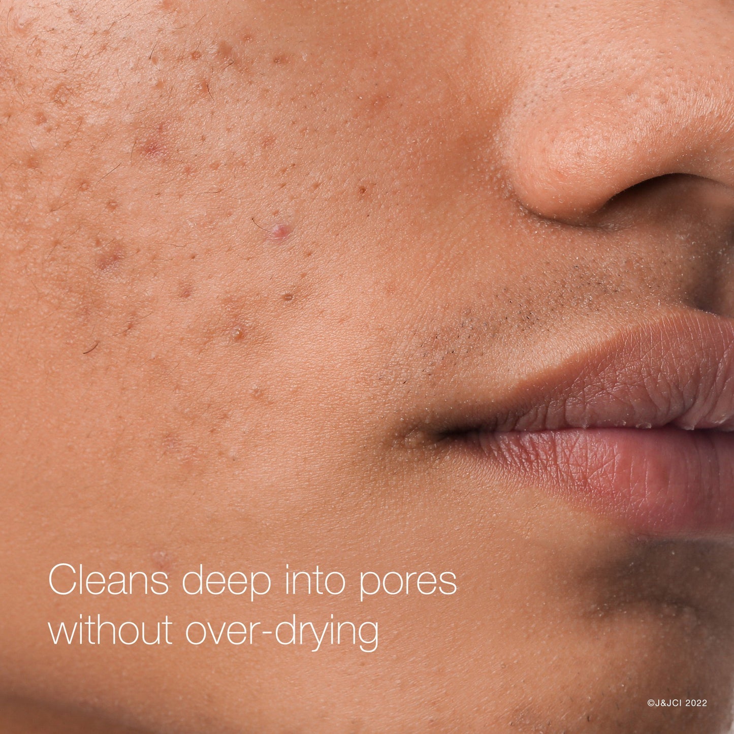 Neutrogena Rapid Clear Maximum Strength Acne Treatment Pads