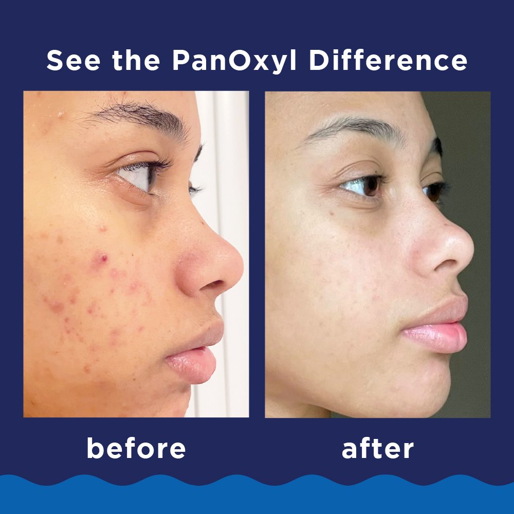 PanOxyl Face & Body Maximum Strength Acne Foaming Wash