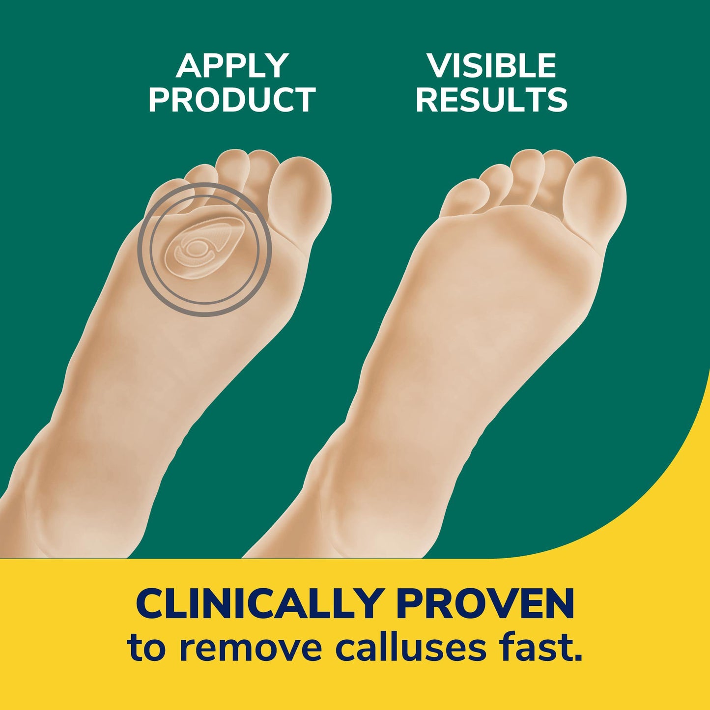 Dr. Scholl's Callus Removers
