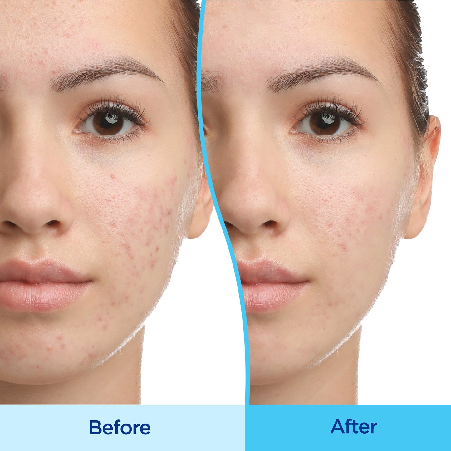 Differin Gel Acne Treatment 0.1% Adapalene