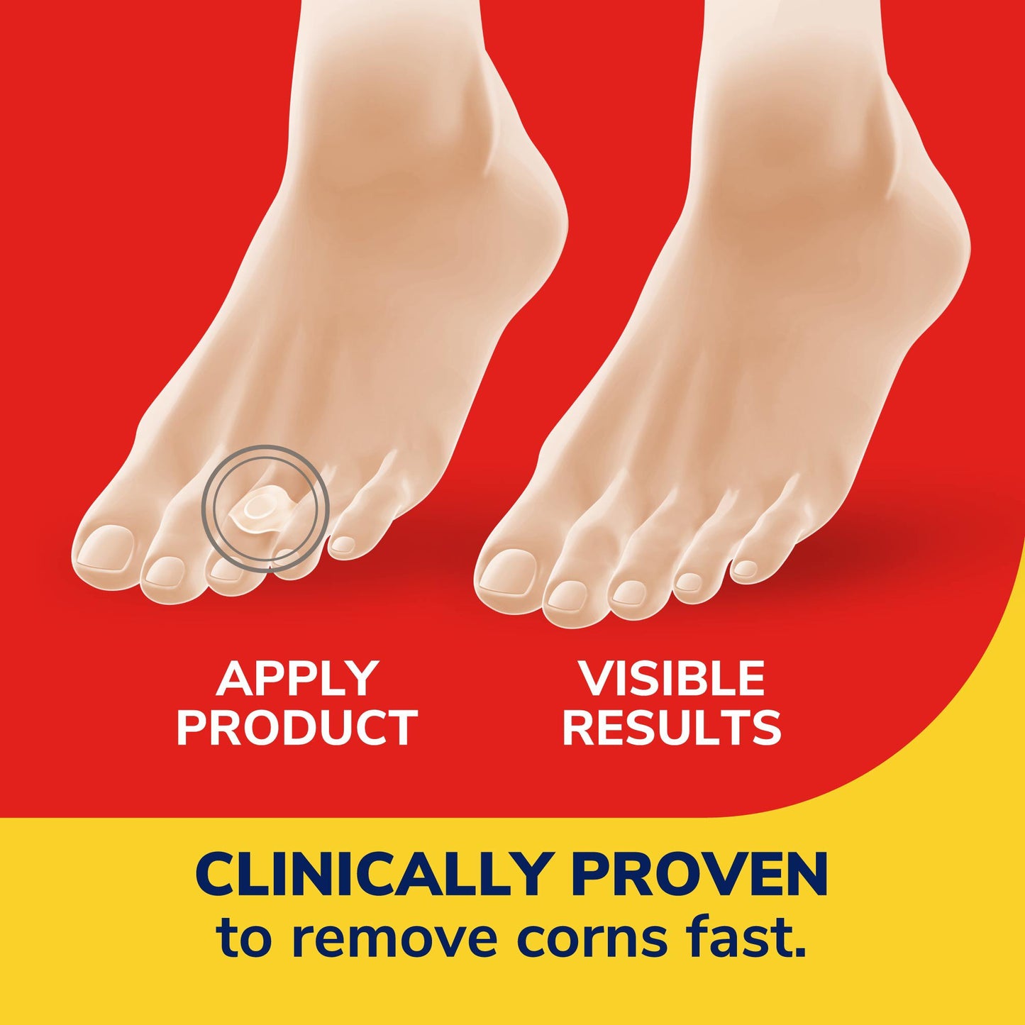 Dr. Scholl's Corn Removers