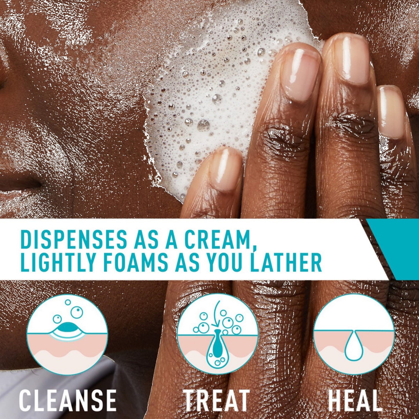 CeraVe Acne Foaming Cream Cleanser