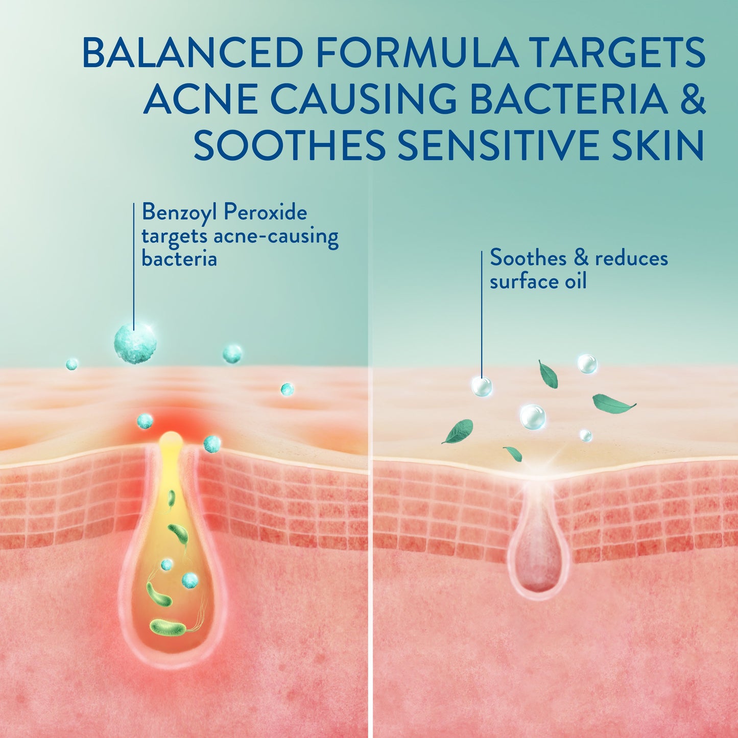 Cetaphil Gentle Clear Complexion-Clearing BPO Acne Cleanser