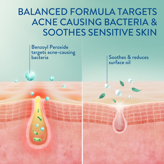 Cetaphil Gentle Clear Complexion-Clearing BPO Acne Cleanser