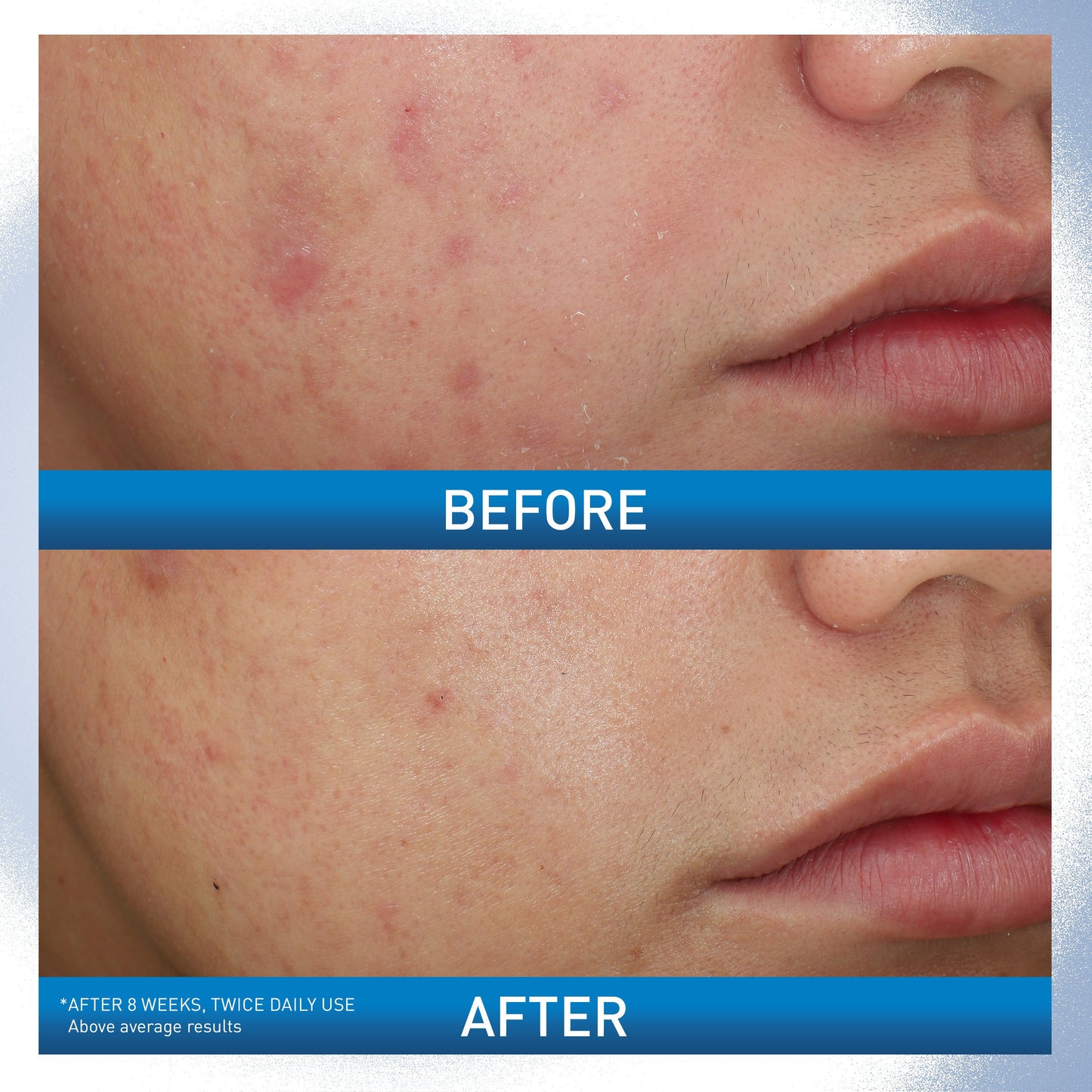 CeraVe Acne Foaming Cream Wash